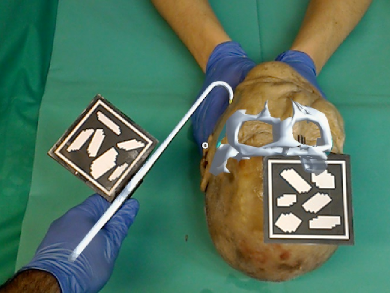 Augmented Reality-Based Surgery on the Human Cadaver Using a New Generation of Optical Head-Mounted Displays: Development and Feasibility Study