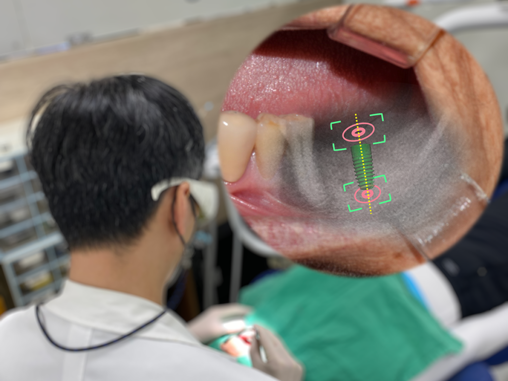 Accuracy of Augmented RealityAssisted Navigation in Dental Implant Surgery Systematic Review
