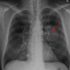 Prognosticating Lung Cancer with Artificial Intelligence Is Now Possible - Gilmore Health News