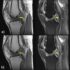 Artificial Intelligence Reconstructs Missing Data From Rapid MRI Scans