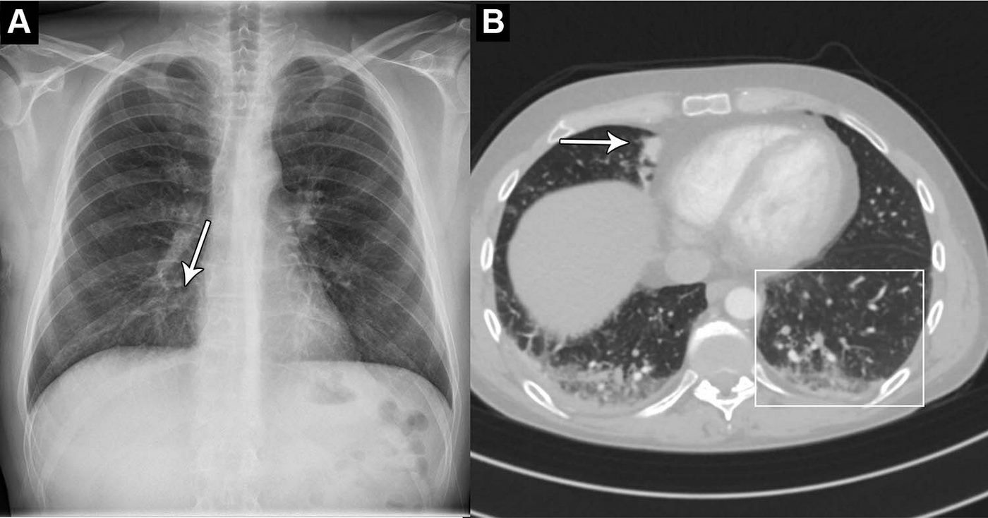 Artificial Intelligence 'Can Help Spot Early Signs of Cancer in Chest X-Rays'
